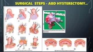 SURGICAL STEPS - ABD HYSTERECTOMY..
 