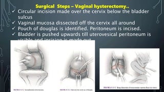 Surgical Steps – Vaginal hysterectomy..
 Circular incision made over the cervix below the bladder
sulcus
 Vaginal mucosa dissected off the cervix all around
 Pouch of douglas is identified. Peritoneum is incised.
 Bladder is pushed upwards till uterovesical peritoneum is
visible and incision is made out.
 