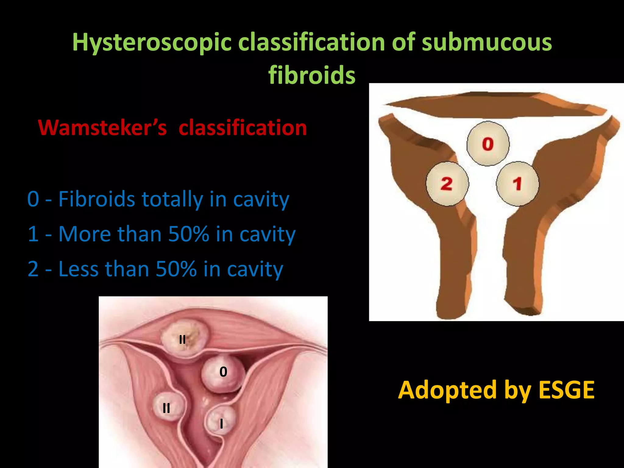Fibroid Classification Hysteroscopic classification of submucous fibroids | PPTX