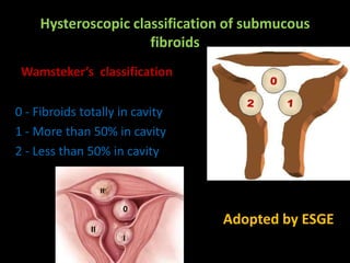 Hysteroscopic classification of submucous
                     fibroids
 Wamsteker’s classification

0 - Fibroids totally in cavity
1 - More than 50% in cavity
2 - Less than 50% in cavity

                    II

                         0
                                 Adopted by ESGE
               II
                         I
 