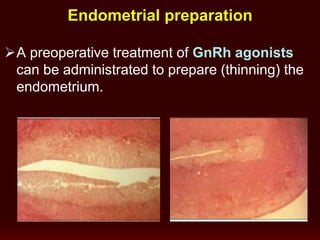 Endometrial preparation
A preoperative treatment of GnRh agonists
can be administrated to prepare (thinning) the
endometrium.
 