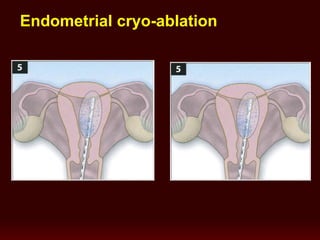 Endometrial cryo-ablation
 