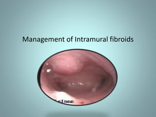 Management of Intramural fibroids 
 