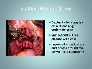 da Vinci Hysterectomy 
 Dexterity for complex 
dissections (e.g 
endometriosis) 
 Vaginal cuff suture 
closure with ease 
 Improved visualization 
and access around the 
cervix for a colpotomy 
 