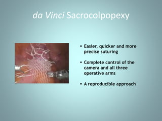 da Vinci Sacrocolpopexy 
 Easier, quicker and more 
precise suturing 
 Complete control of the 
camera and all three 
operative arms 
 A reproducible approach 
 