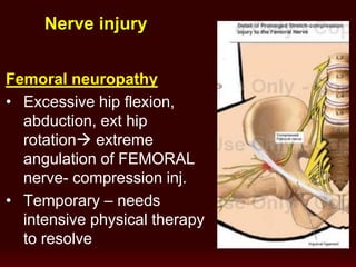 Femoral neuropathy
• Excessive hip flexion,
abduction, ext hip
rotation extreme
angulation of FEMORAL
nerve- compression inj.
• Temporary – needs
intensive physical therapy
to resolve
Nerve injury
 