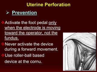  Prevention
Activate the foot pedal only
when the electrode is moving
toward the operator, not the
fundus.
Never activate the device
during a forward movement.
Use roller-ball based
device at the cornu.
Uterine Perforation
 