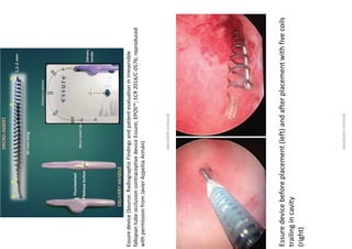 Hysteroscopy indication | PDF
