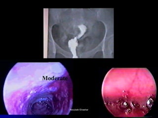 63 
Severe 
Moderate 
Aboubakr ElnasharAboubakr Elnashar  
