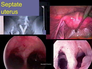 Septate uterus 
. 
Aboubakr ElnasharAboubakr Elnashar  