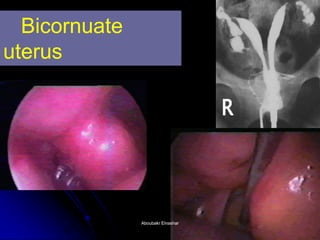 Bicornuate uterus 
Aboubakr ElnasharAboubakr Elnashar  