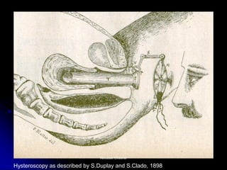 Hysteroscopy as described by S.Duplay and S.Clado, 1898 
Aboubakr ElnasharAboubakr Elnashar  