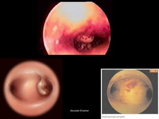 55 
52 
Cornual polyp 
Aboubakr ElnasharAboubakr Elnashar  