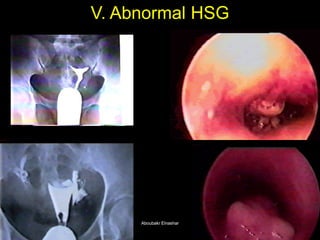 V. Abnormal HSG 
Aboubakr ElnasharAboubakr Elnashar  