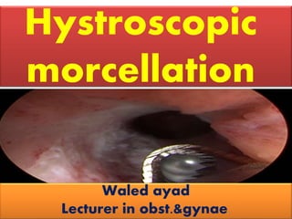 Hystroscopic
morcellation
Waled ayad
Lecturer in obst.&gynae.
 