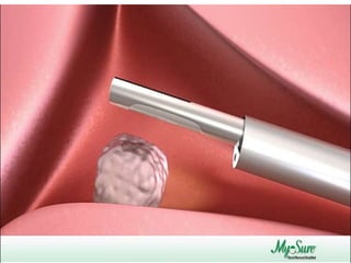 Hystroscopic morcellation..waled ayad | PPT