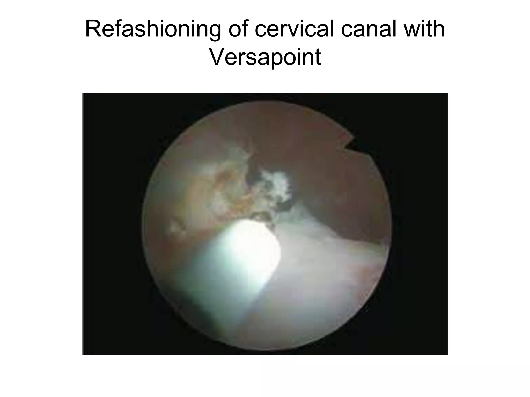 Role of Hysteroscopy in Difficult Embryo Transfers | PPTX