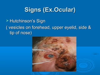 Signs (Ex.Ocular)
 Hutchinson’s Sign

( vesicles on forehead, upper eyelid, side &
  tip of nose)
 