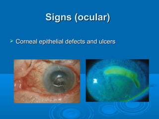 Signs (ocular)

   Corneal epithelial defects and ulcers
 