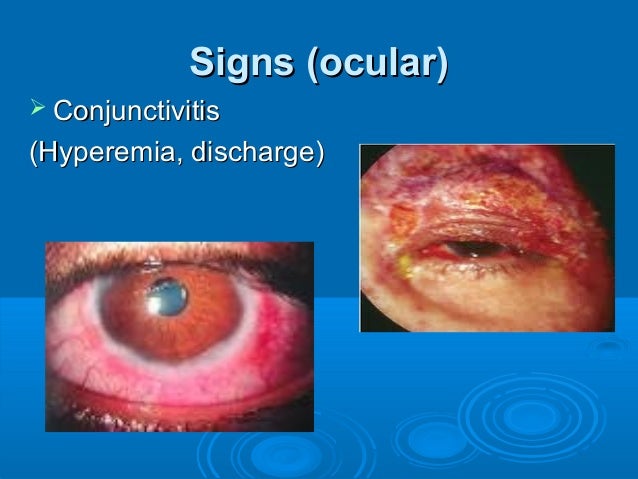Herpes Zoster Ophthalmicus