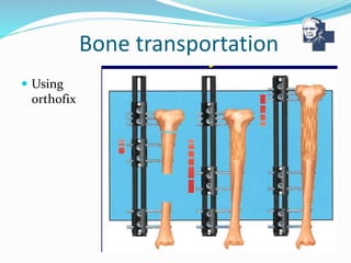 Bone Transfer Ilizarov technique - The answer for non union | PPTX