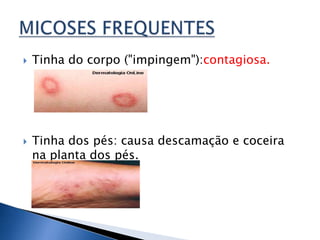    Tinha do corpo ("impingem"):contagiosa.




   Tinha dos pés: causa descamação e coceira
    na planta dos pés.
 