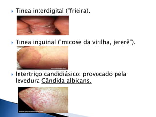    Tinea interdigital ("frieira).




   Tinea inguinal ("micose da virilha, jererê").




   Intertrigo candidiásico: provocado pela
    levedura Cândida albicans.
 