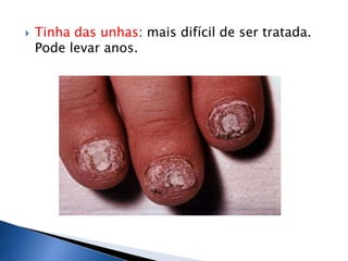    Tinha das unhas: mais difícil de ser tratada.
    Pode levar anos.
 