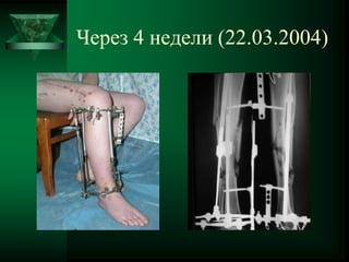 Через 4 недели (22.03.2004)
 