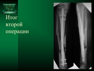 Итог
второй
операции
 