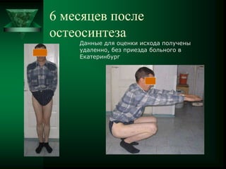 6 месяцев после
остеосинтеза
Данные для оценки исхода получены
удаленно, без приезда больного в
Екатеринбург
 