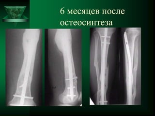 6 месяцев после
остеосинтеза
 