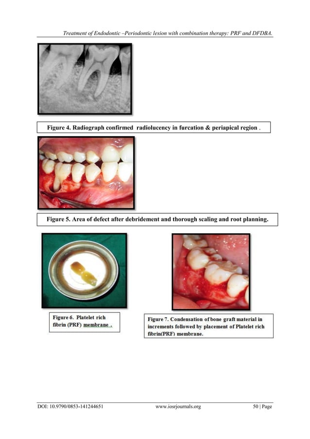 Treatment of Endodontic Periodontic lesion with combination therapy