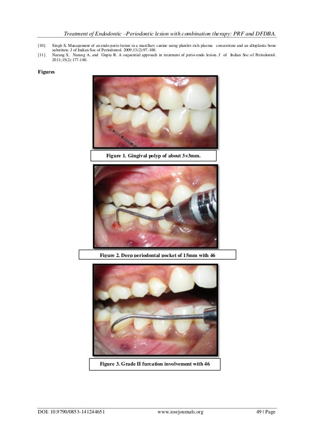 Treatment of Endodontic Periodontic lesion with combination therapy…