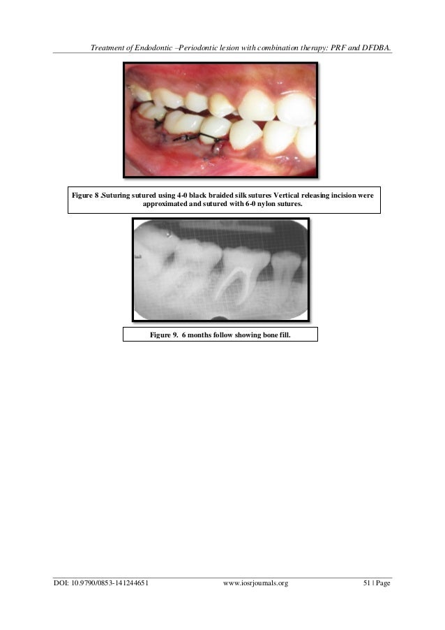 Treatment of Endodontic Periodontic lesion with combination therapy…