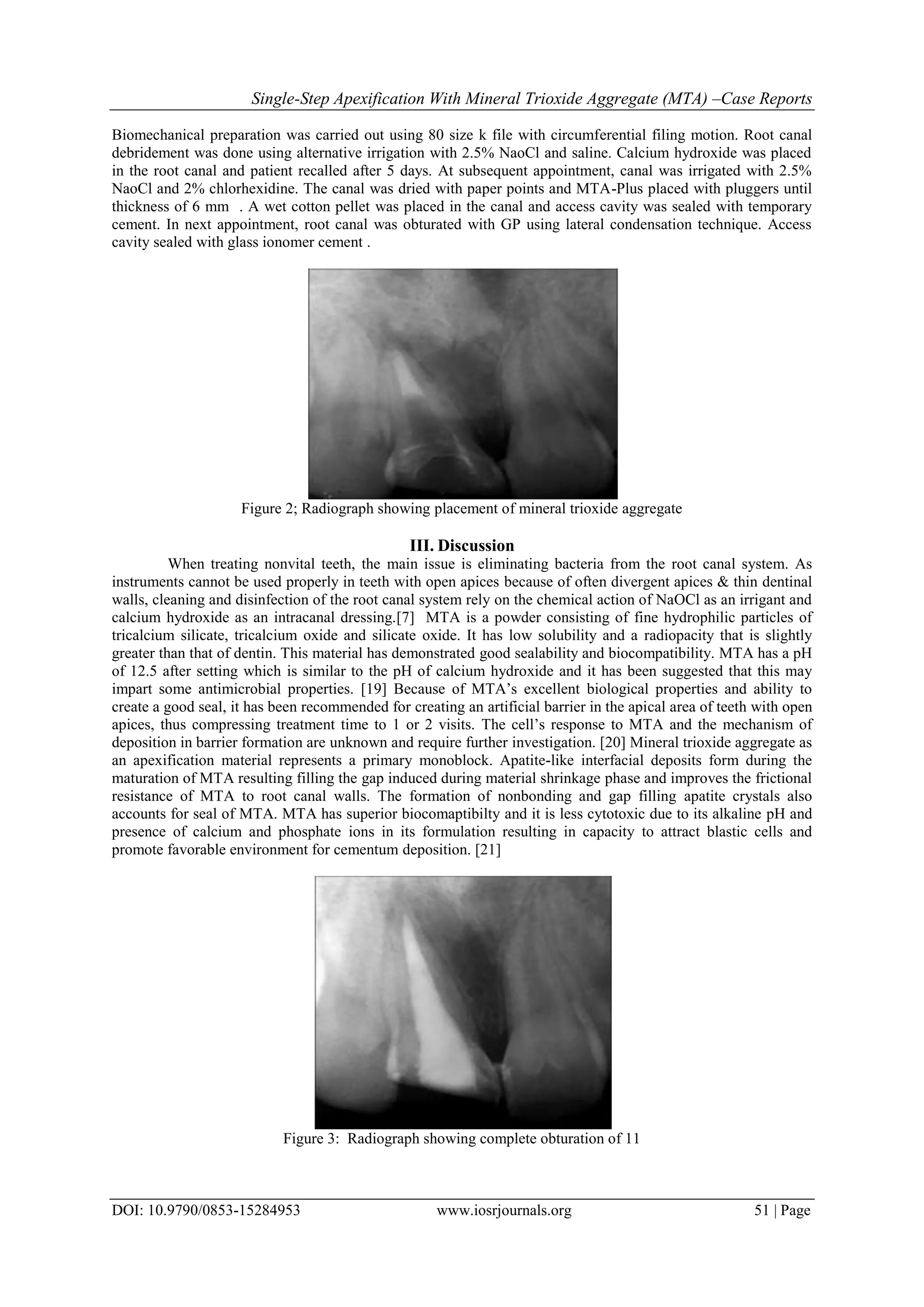 Single-Step Apexification With Mineral Trioxide Aggregate (MTA) –Case Reports
DOI: 10.9790/0853-15284953 www.iosrjournals.org 51 | Page
Biomechanical preparation was carried out using 80 size k file with circumferential filing motion. Root canal
debridement was done using alternative irrigation with 2.5% NaoCl and saline. Calcium hydroxide was placed
in the root canal and patient recalled after 5 days. At subsequent appointment, canal was irrigated with 2.5%
NaoCl and 2% chlorhexidine. The canal was dried with paper points and MTA-Plus placed with pluggers until
thickness of 6 mm . A wet cotton pellet was placed in the canal and access cavity was sealed with temporary
cement. In next appointment, root canal was obturated with GP using lateral condensation technique. Access
cavity sealed with glass ionomer cement .
Figure 2; Radiograph showing placement of mineral trioxide aggregate
III. Discussion
When treating nonvital teeth, the main issue is eliminating bacteria from the root canal system. As
instruments cannot be used properly in teeth with open apices because of often divergent apices & thin dentinal
walls, cleaning and disinfection of the root canal system rely on the chemical action of NaOCl as an irrigant and
calcium hydroxide as an intracanal dressing.[7] MTA is a powder consisting of fine hydrophilic particles of
tricalcium silicate, tricalcium oxide and silicate oxide. It has low solubility and a radiopacity that is slightly
greater than that of dentin. This material has demonstrated good sealability and biocompatibility. MTA has a pH
of 12.5 after setting which is similar to the pH of calcium hydroxide and it has been suggested that this may
impart some antimicrobial properties. [19] Because of MTA’s excellent biological properties and ability to
create a good seal, it has been recommended for creating an artificial barrier in the apical area of teeth with open
apices, thus compressing treatment time to 1 or 2 visits. The cell’s response to MTA and the mechanism of
deposition in barrier formation are unknown and require further investigation. [20] Mineral trioxide aggregate as
an apexification material represents a primary monoblock. Apatite-like interfacial deposits form during the
maturation of MTA resulting filling the gap induced during material shrinkage phase and improves the frictional
resistance of MTA to root canal walls. The formation of nonbonding and gap filling apatite crystals also
accounts for seal of MTA. MTA has superior biocomaptibilty and it is less cytotoxic due to its alkaline pH and
presence of calcium and phosphate ions in its formulation resulting in capacity to attract blastic cells and
promote favorable environment for cementum deposition. [21]
Figure 3: Radiograph showing complete obturation of 11
 