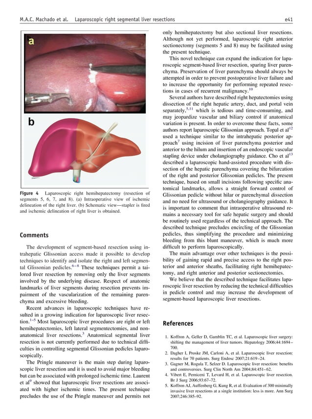 Glissonian approach for laparoscopic liver resections | PDF