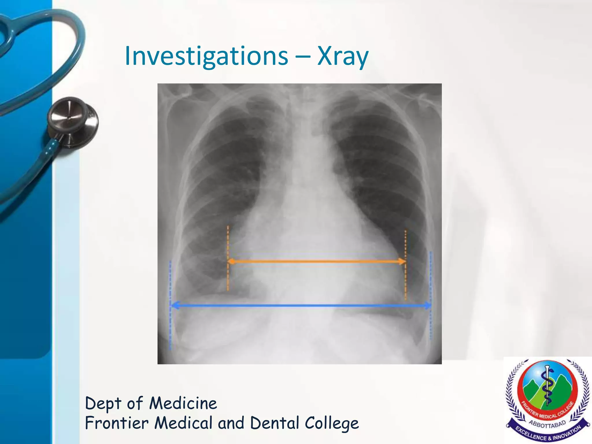 Myocardial Infarction - Case Presentation and an Overview | PPTX