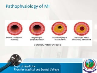 Pathophysiology of MI
Dept of Medicine
Frontier Medical and Dental College
 