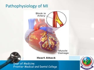 Pathophysiology of MI
Dept of Medicine
Frontier Medical and Dental College
 