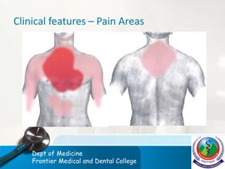 Clinical features – Pain Areas
Dept of Medicine
Frontier Medical and Dental College
 