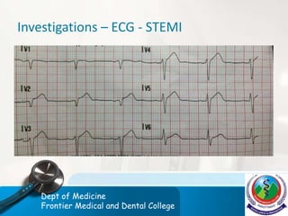 Investigations – ECG - STEMI
Dept of Medicine
Frontier Medical and Dental College
 