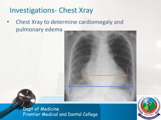 Investigations- Chest Xray
• Chest Xray to determine cardiomegaly and
pulmonary edema
Dept of Medicine
Frontier Medical and Dental College
 