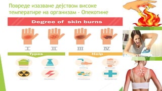 Zdravstvena zastita sa prvom pomoci-opekotine | PPTX