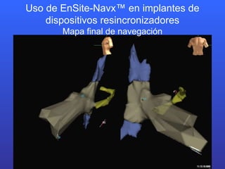 Uso de EnSite-Navx™ en implantes de dispositivos resincronizadores Mapa final de navegación 
