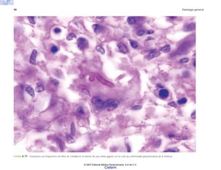 98 Patología general
FIGURA 6-17. Granuloma con fragmentos de hifas de Candida en el interior de una célula gigante en un caso de enfermedad granulomatosa de la infancia.
© 2007 Editorial Médica Panamericana, S.A de C.V.
Cisfarm
 