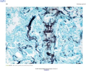 100 Patología general
FIGURA 6-19. Hifas cortas y anchas de la infección por Mucor.
© 2007 Editorial Médica Panamericana, S.A de C.V.
Cisfarm
 