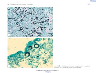 C6 Patología de las enfermedades infecciosas 101
FIGURA 6-20. a) Hifas delgadas y ramificadas en ángulo agudo de Aspergillus. b)
Conidióforos con la vesícula y las conidias en forma de rayos.
(b)
(a)
© 2007 Editorial Médica Panamericana, S.A de C.V.
Cisfarm
 