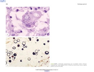 102 Patología general
FIGURA 6-21. a) Meningitis granulomatosa por Coccidiodes inmitis. Esférulas
facogitadas por células gigantes (HE). b) Tinción de Grocott que revela la cápsula
positiva a la tinción de plata.
(b)
(a)
© 2007 Editorial Médica Panamericana, S.A de C.V.
Cisfarm
 