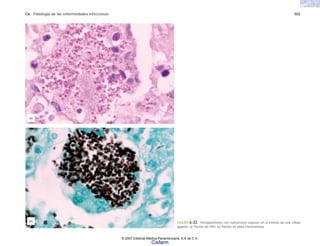C6 Patología de las enfermedades infecciosas 103
FIGURA 6-22. Histoplasmosis con numerosos esporas en el interior de una célula
gigante. a) Tinción de PAS. b) Tinción de plata metenamina.
(b)
(a)
© 2007 Editorial Médica Panamericana, S.A de C.V.
Cisfarm
 